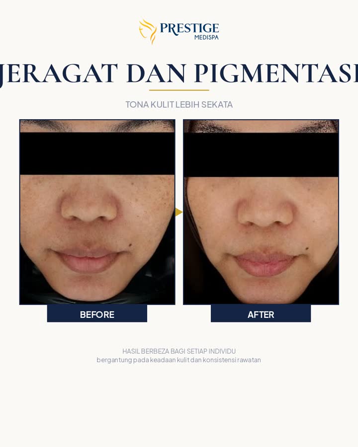 Jeragat dan pigmentasi sebelum dan selepas di Prestige Medispa Gombak