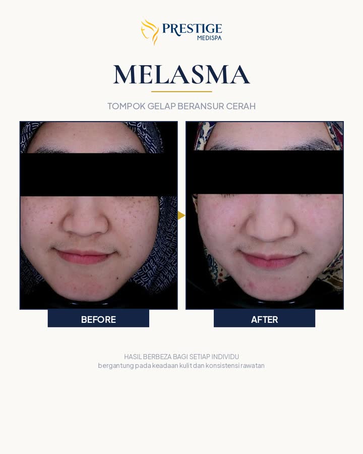 Melasma sebelum dan selepas di Prestige Medispa Gombak