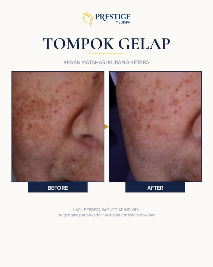 Tompok gelap sebelum dan selepas di Prestige Medispa Gombak