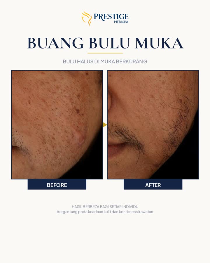 Buang bulu muka sebelum dan selepas di Prestige Medispa Gombak