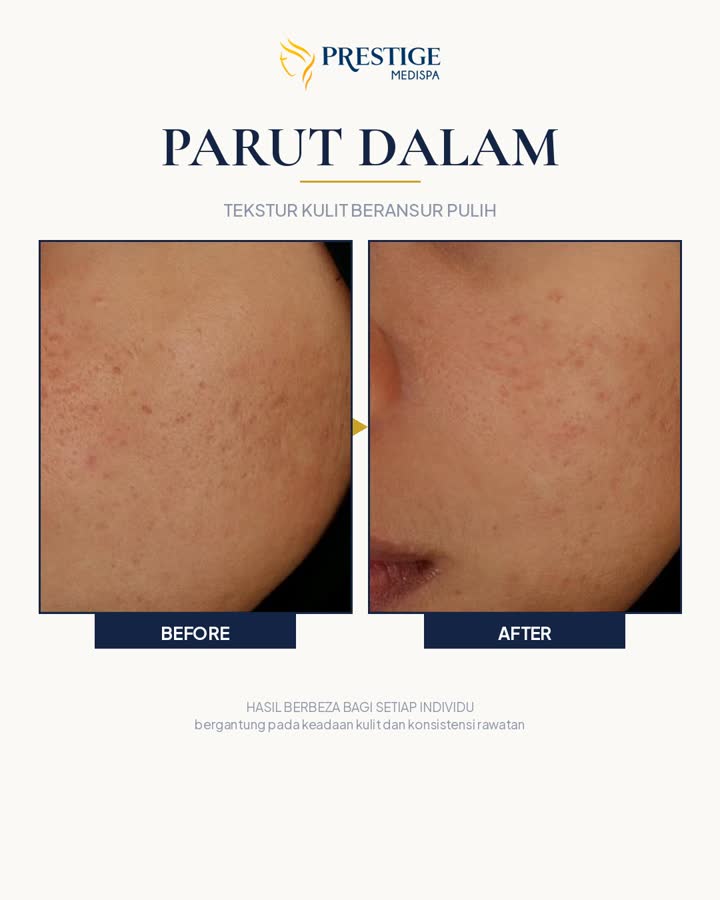 Parut dalam sebelum dan selepas di Prestige Medispa Gombak