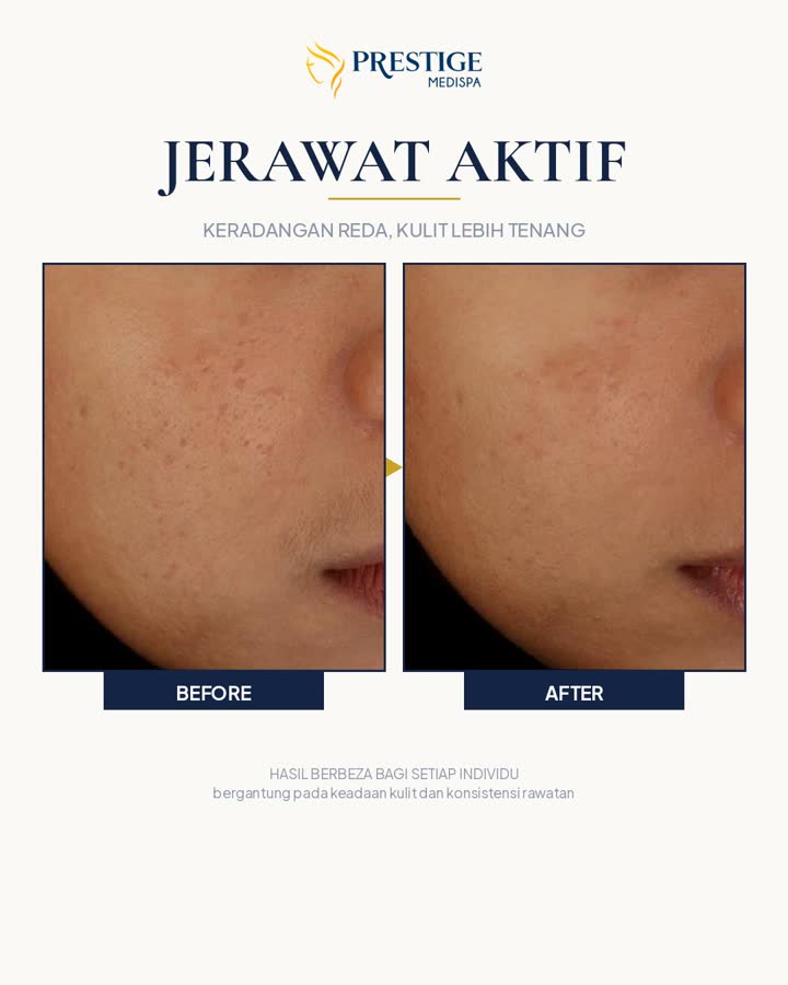 Jerawat aktif sebelum dan selepas di Prestige Medispa Gombak