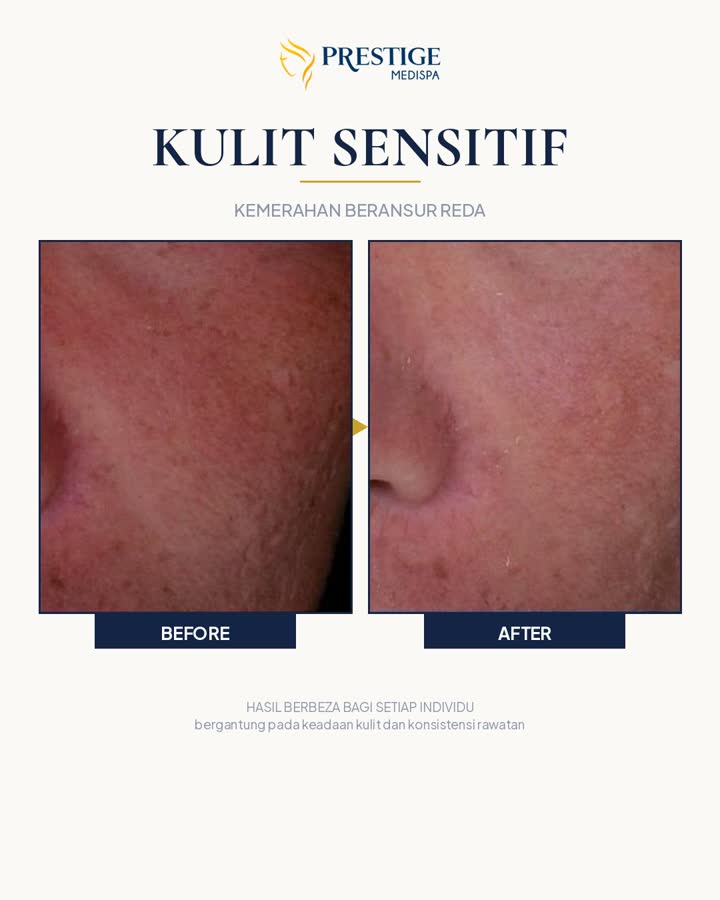 Kulit sensitif sebelum dan selepas di Prestige Medispa Gombak