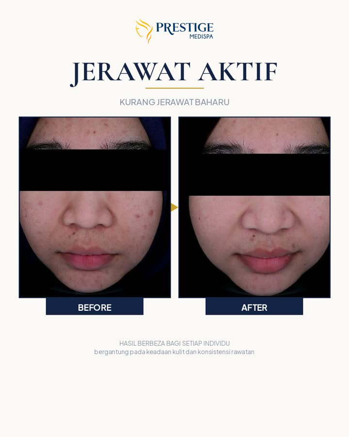 Jerawat aktif sebelum dan selepas di Prestige Medispa Gombak