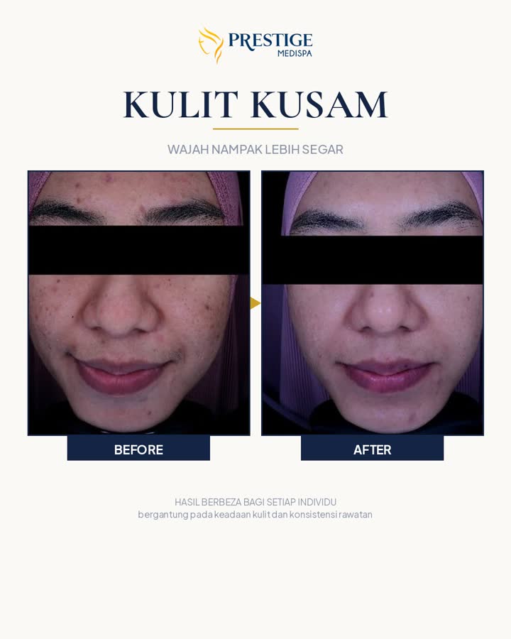 Kulit kusam sebelum dan selepas di Prestige Medispa Gombak