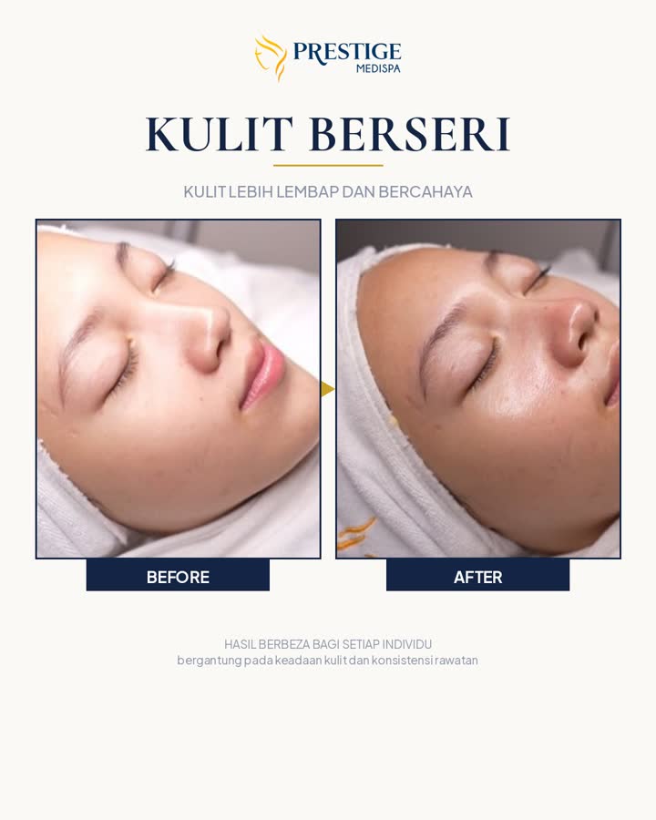 Kulit berseri sebelum dan selepas di Prestige Medispa Gombak