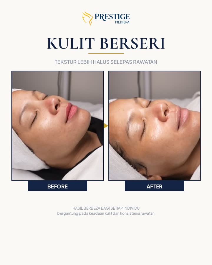 Kulit berseri sebelum dan selepas di Prestige Medispa Gombak