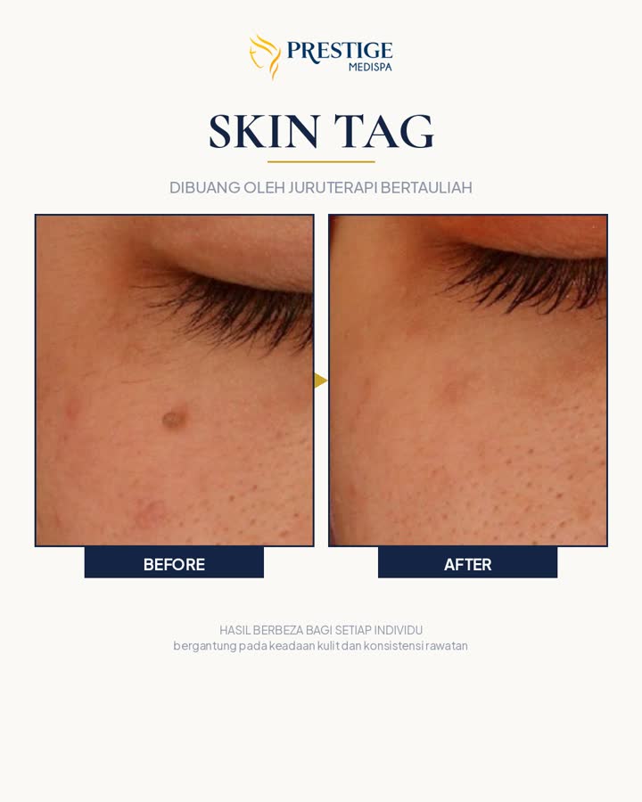 Skin tag sebelum dan selepas di Prestige Medispa Gombak