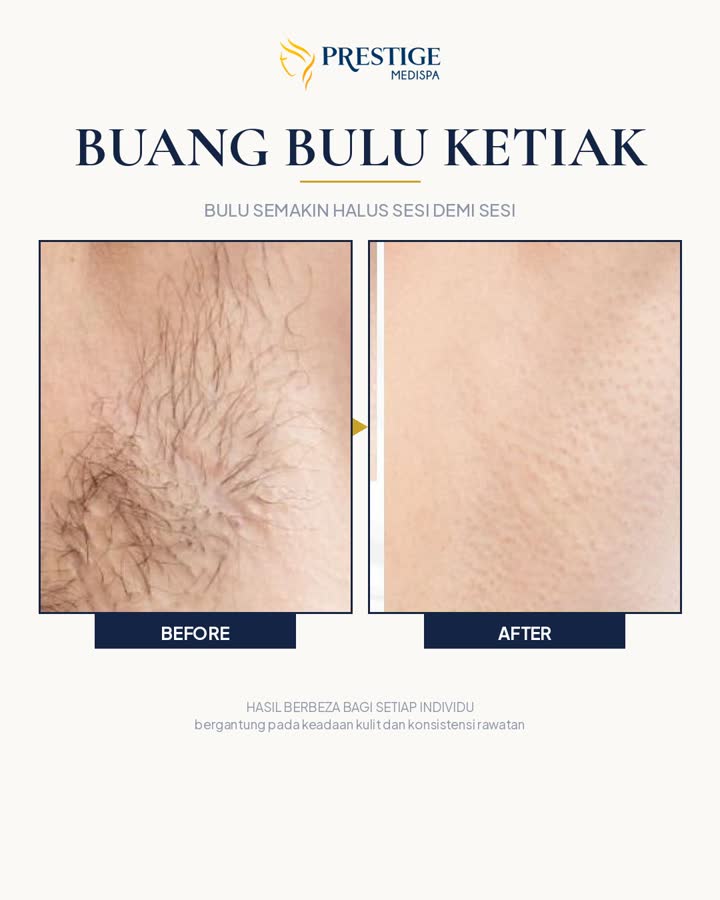 Buang bulu ketiak sebelum dan selepas di Prestige Medispa Gombak