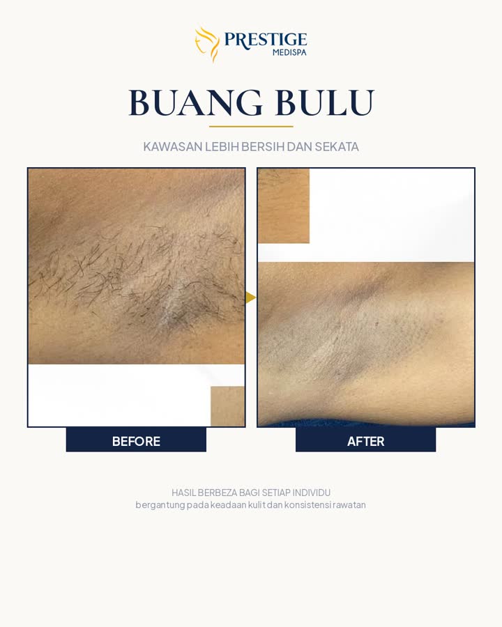 Buang bulu sebelum dan selepas di Prestige Medispa Gombak