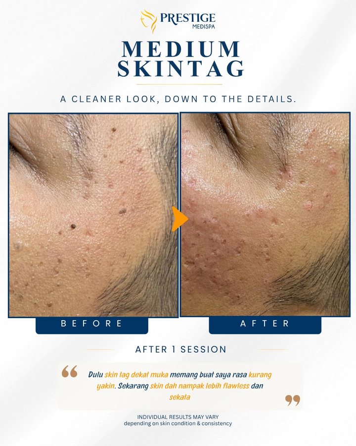 Skin tag sederhana di muka sebelum dan selepas di Prestige Medispa Gombak
