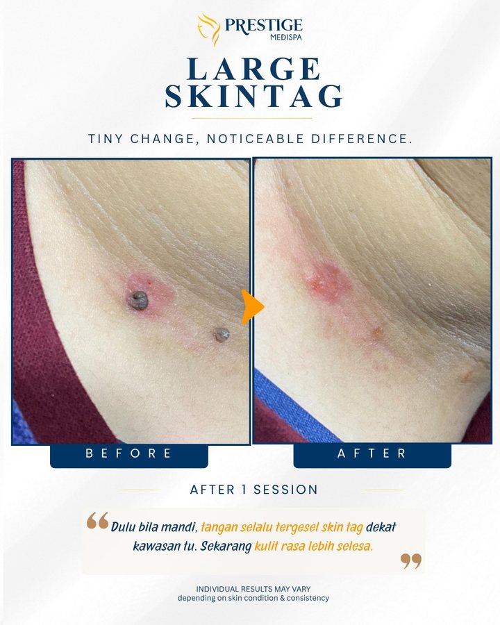 Skin tag besar sebelum dan selepas di Prestige Medispa Gombak